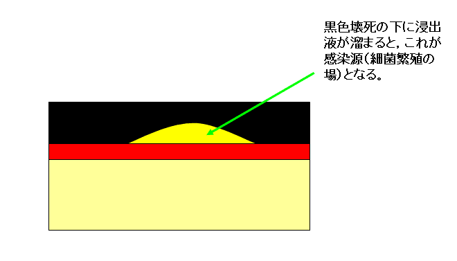 壊死 組織 デブリ