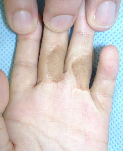 黒ずみ 指 の 関節 【ばね指(バネ指)の治し方】マッサージとテーピングで改善する方法 指の体操とツボ押しも紹介