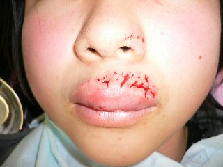 新しい創傷治療：口唇犬咬傷