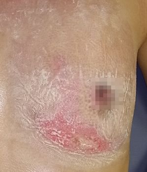 【極美品】創傷の治癒 Wound healing 二次治癒フォーム状創傷被覆・保護材 ハイドロサイト AD