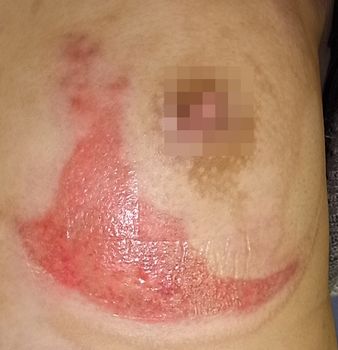 【極美品】創傷の治癒 Wound healing 🌟全网热推·全新技术【TiSuZhen体雕】💫 立即效果可达30
