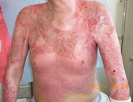 新しい創傷治療 全治療例